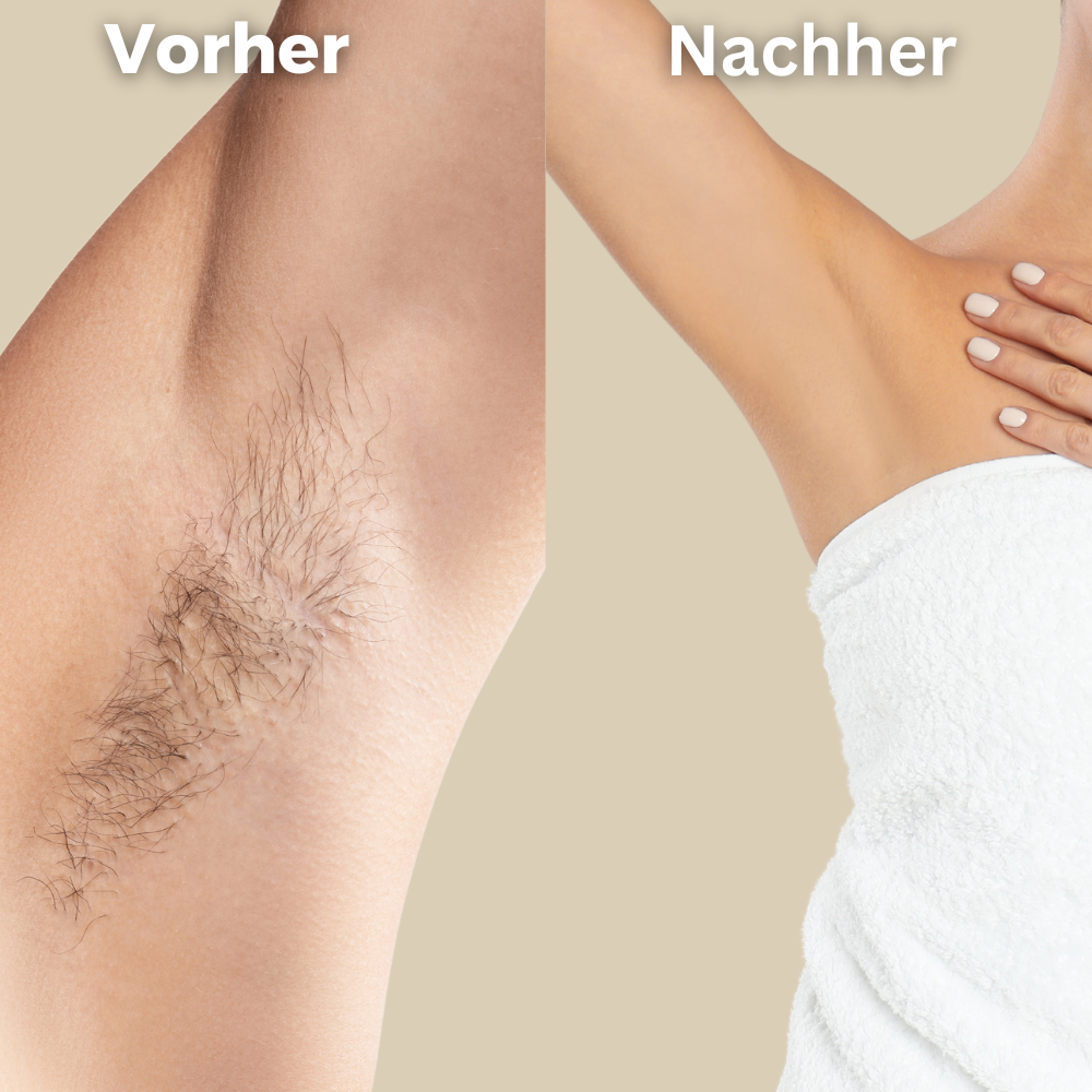 IPL Hair Removal Device - Haarentfernungsgerät